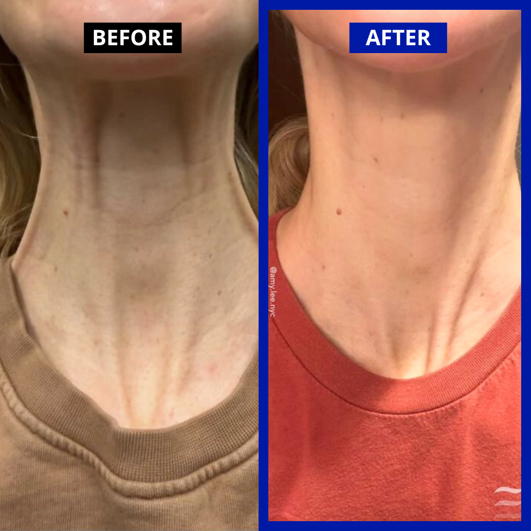 Dr. Melaxin | Neck Wrinkle Removal Set